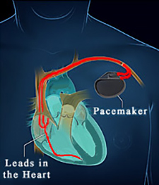 The Woodlands Texas Pacemaker Placement
